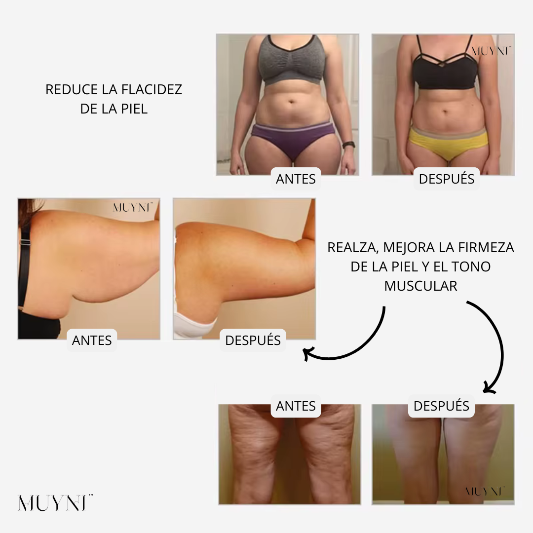 Masajeador MUYNI Anti-Celulitis 4 en 1 - Genesis™️